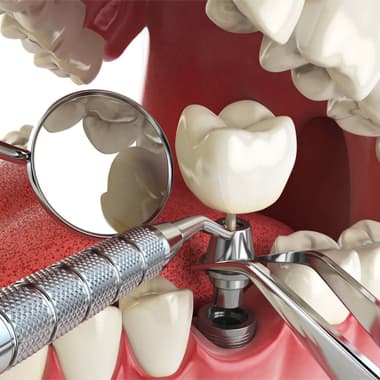 Классическая и одномоментная имплантация зубов