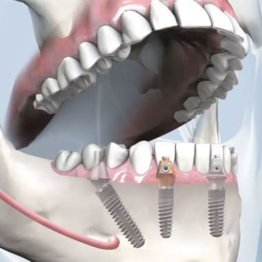 Способы имплантации фронтальных зубов