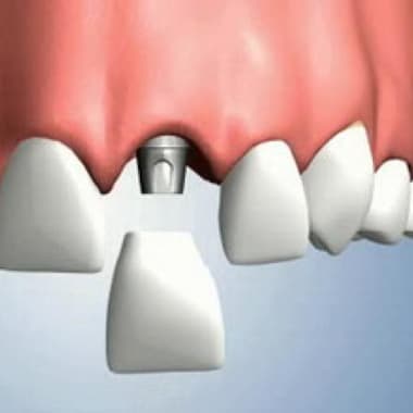Имплантация передних зубов в клинике NovoSmile