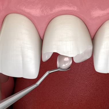 Показания к реставрации зубов