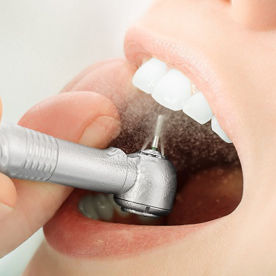 Как проходит процедура профгигиены полости рта