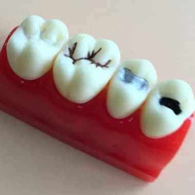 Что такое зубные фиссуры?