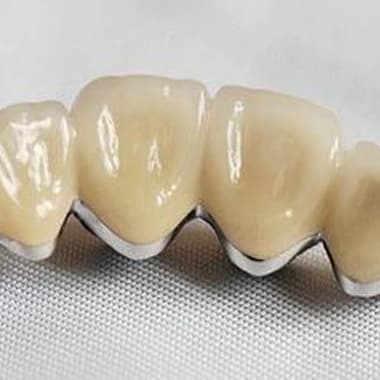 Показания к установке металлокерамических коронок на зубы 