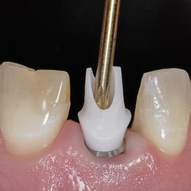 Этапы имплантации передних зубов